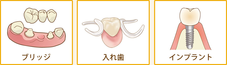 インプラント、入れ歯、ブリッジ